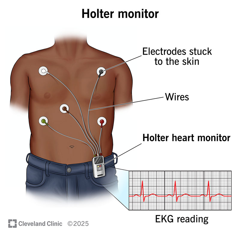 Holter Monitor Purpose Results How It Works