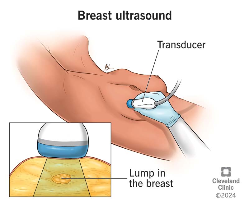 Illustration of ultrasound transducer over breast. Inset shows transducer getting image of tumor inside the breast.