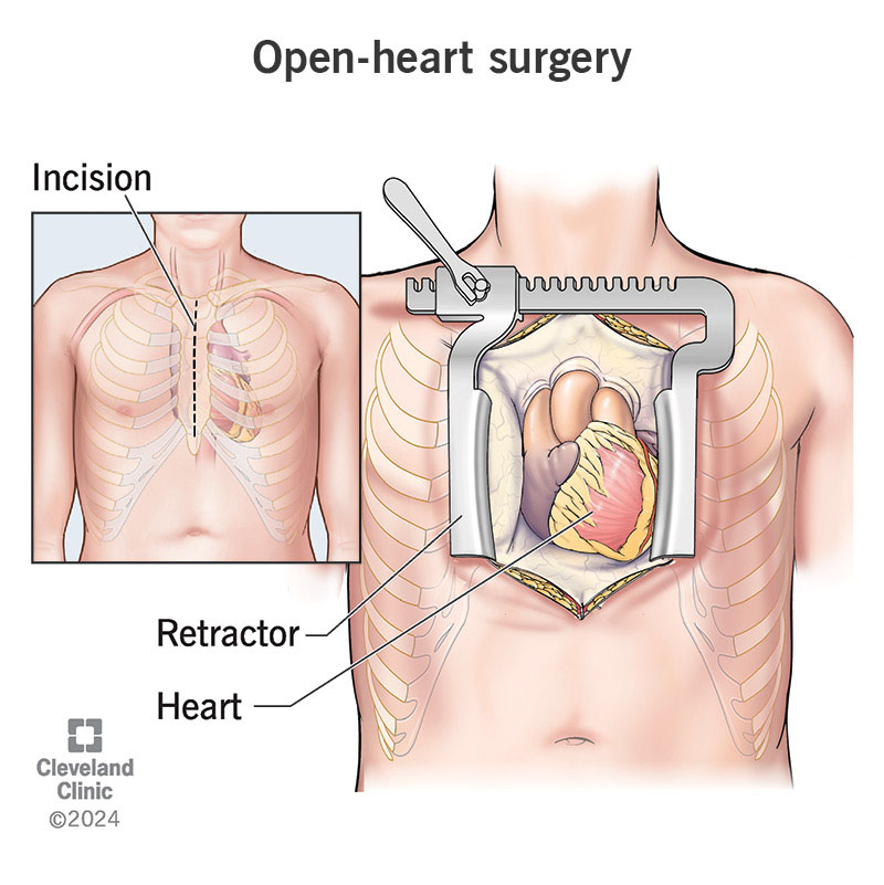 In open-heart surgery, a surgeon cuts through your breastbone and spreads your ribs to access your heart.