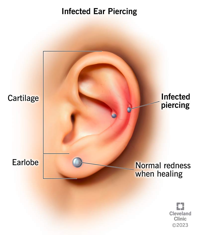 Redness and swelling around your piercing are signs of an ear piercing infection.