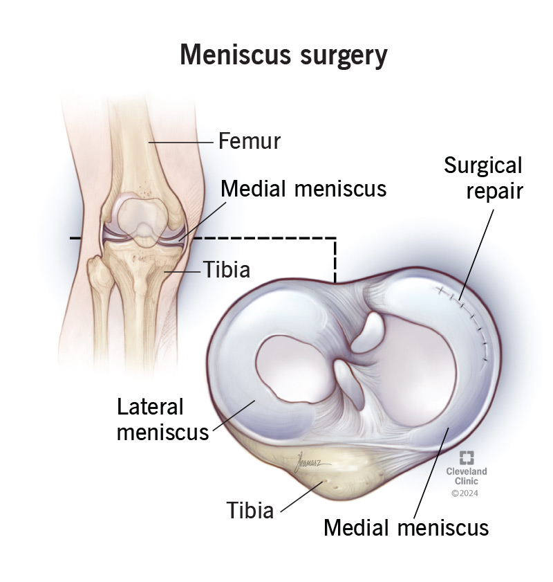 Meniscus repair is a good option for people with lower-grade meniscus tears.