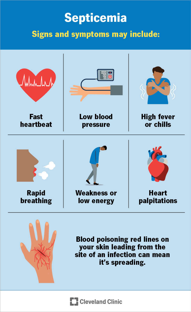 Signs and symptoms of septicemia, including high fever or chills, low blood pressure and heart palpitations