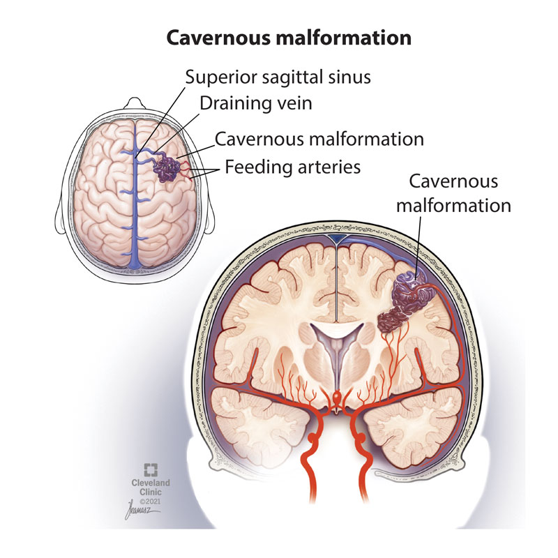 Cavernous Hemangioma Symptoms Treatment Causes   21594 Brain Cavernous Malformation