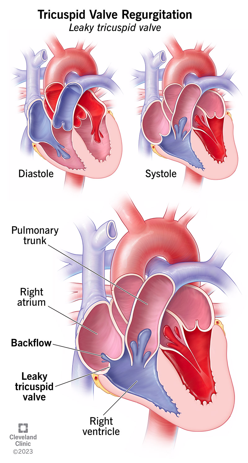 With tricuspid regurgitation blood leaks backward from your right ventricle into your right atrium when your heart contracts.