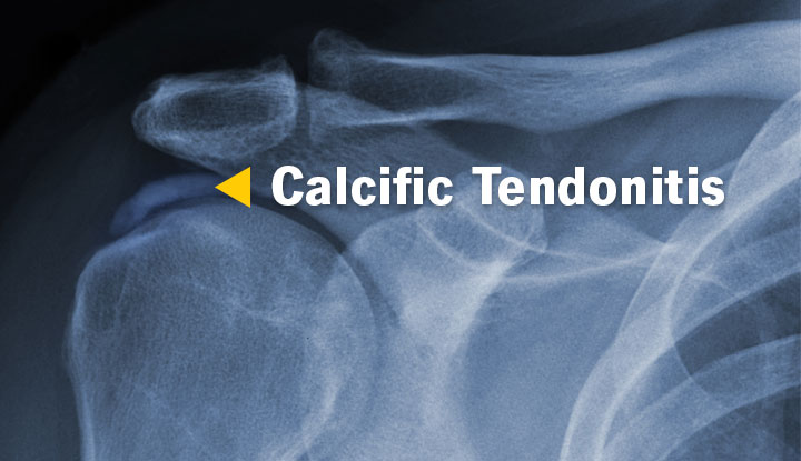 Calcific tendonitis of the shoulder