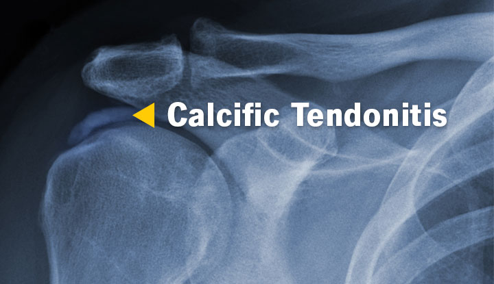 quadriceps tendon calcification