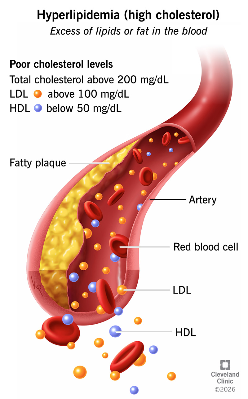 Hyperlipidemia (high cholesterol) is too many fats in your blood, which raises your risk of a stroke or heart attack