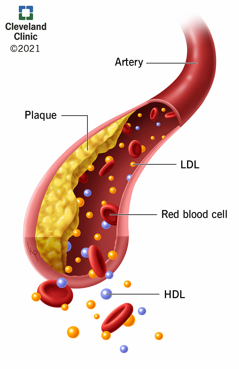 LDL, HDL and plaque inside an artery.
