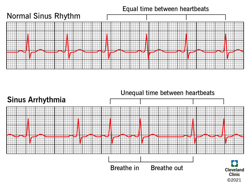 EKG showing sinus arrhythmia.