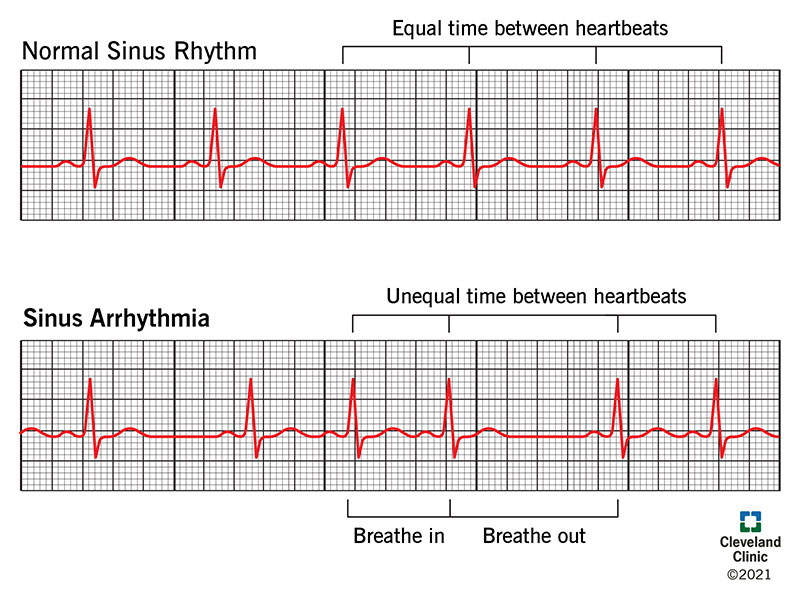 arrhythmia