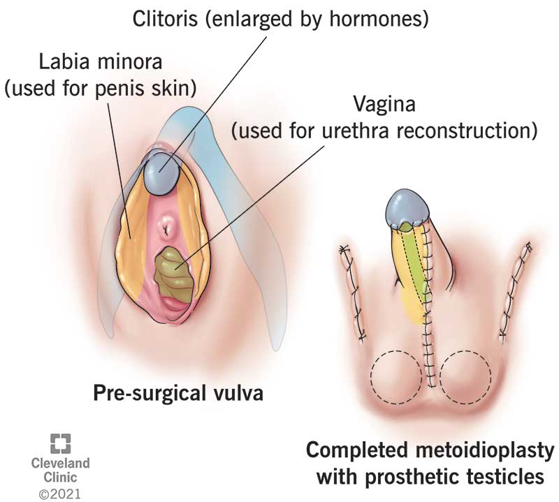 Clitoris enlarged by hormones, labia minora (used for penis skin), vagina (used for urethra reconstruction), pre-surgical vulva, completed metoidioplasty with prosthetic testicles
