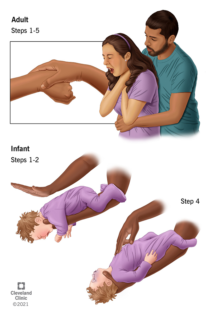 The standard Heimlich maneuver for adults and special methods used on choking infants.