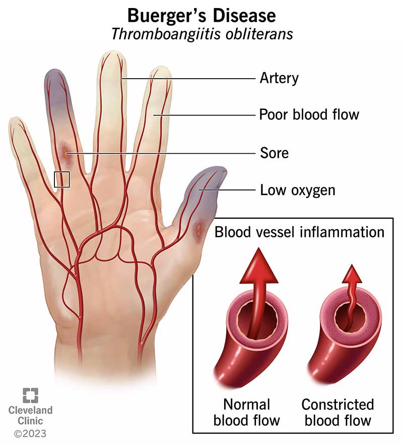 With Buerger’s disease, inflammation in your blood vessels limits blood flow in your fingers, toes, arms and legs.
