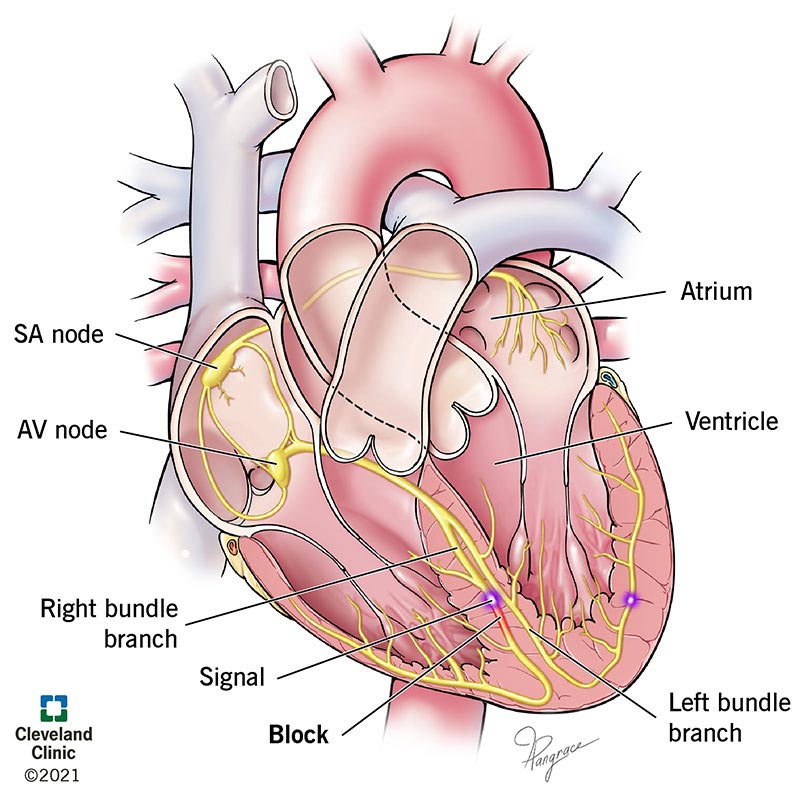 right bundle branch block