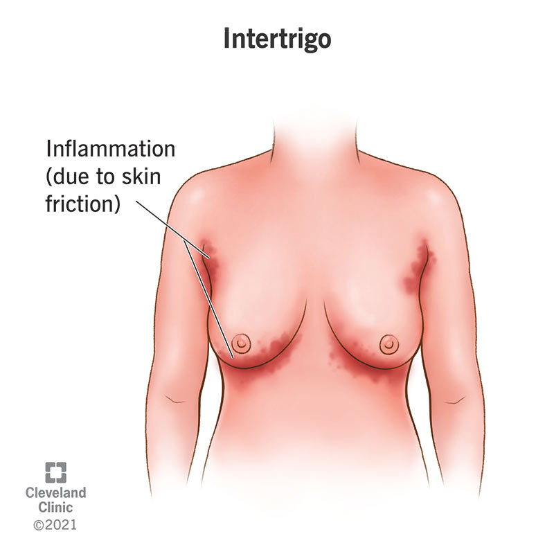 Intertrigo caused by skin friction