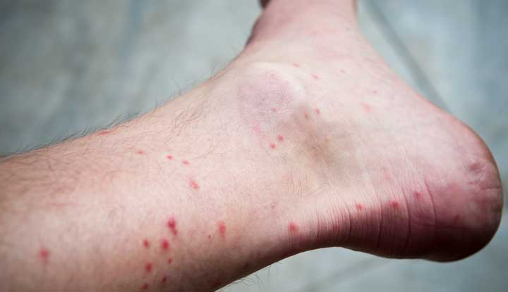Flea bites on a person’s ankle look like small, red bumps.