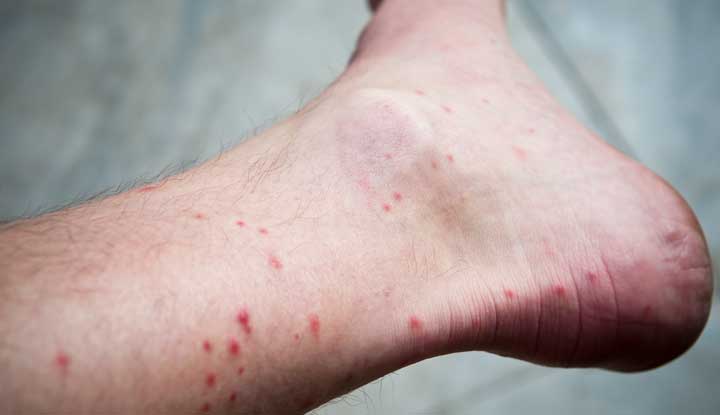 what do dog flea bites look like on humans