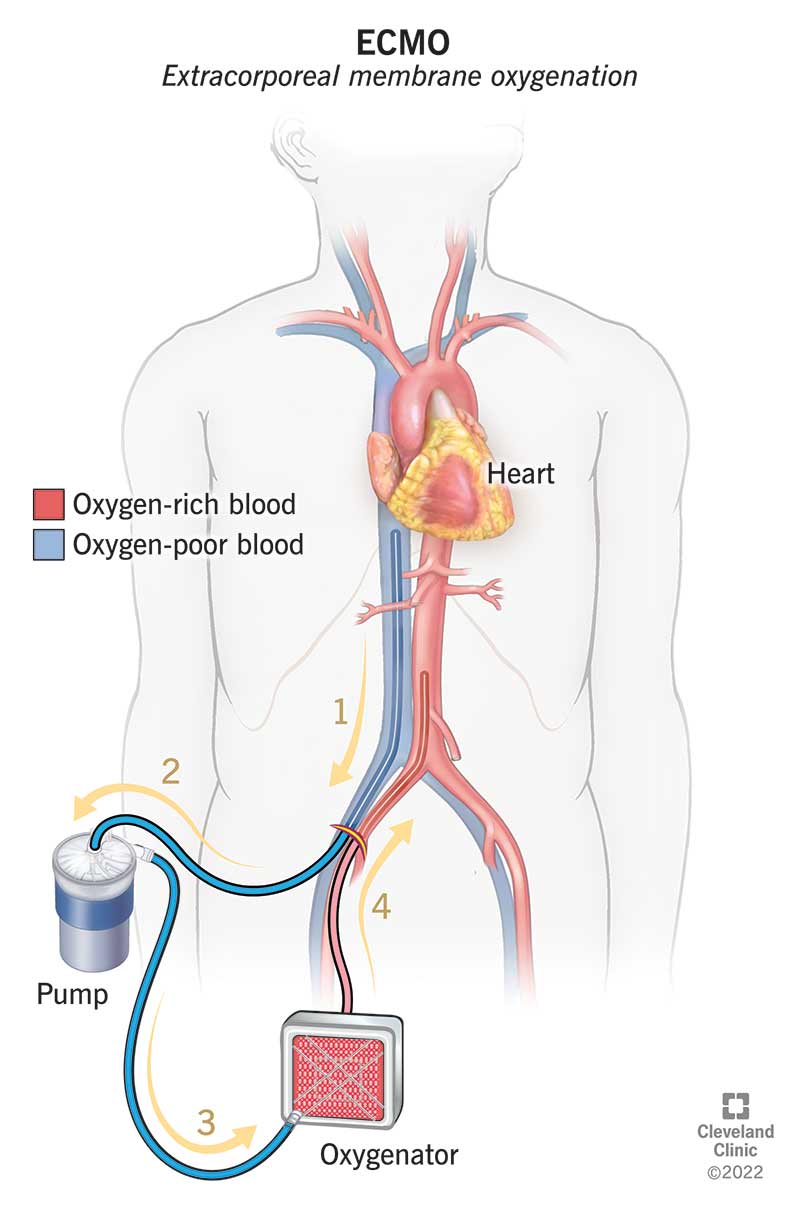 ECMO takes your blood out of your body, adds oxygen and returns blood to your body.