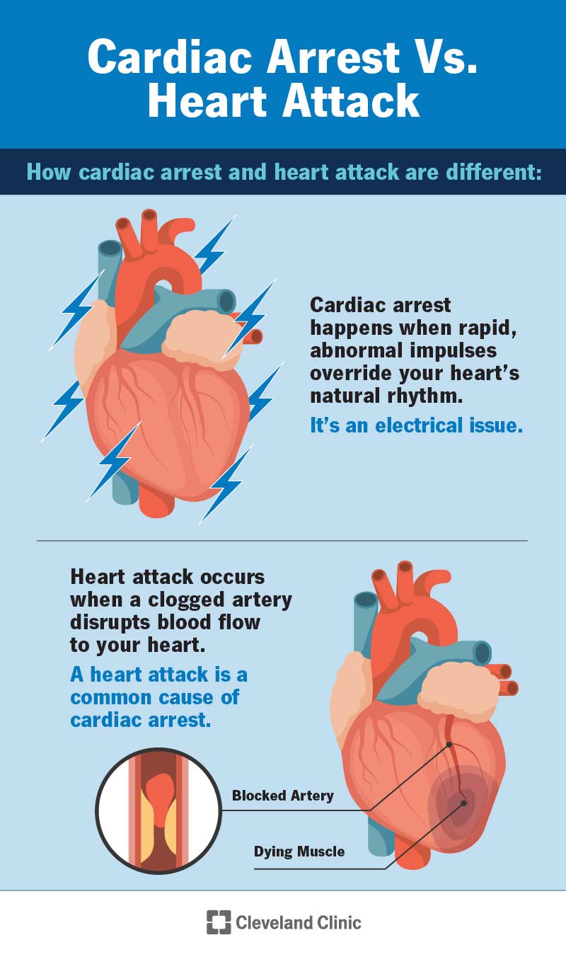 Abnormal signals cause cardiac arrest, but a clog in your artery causes a heart attack.