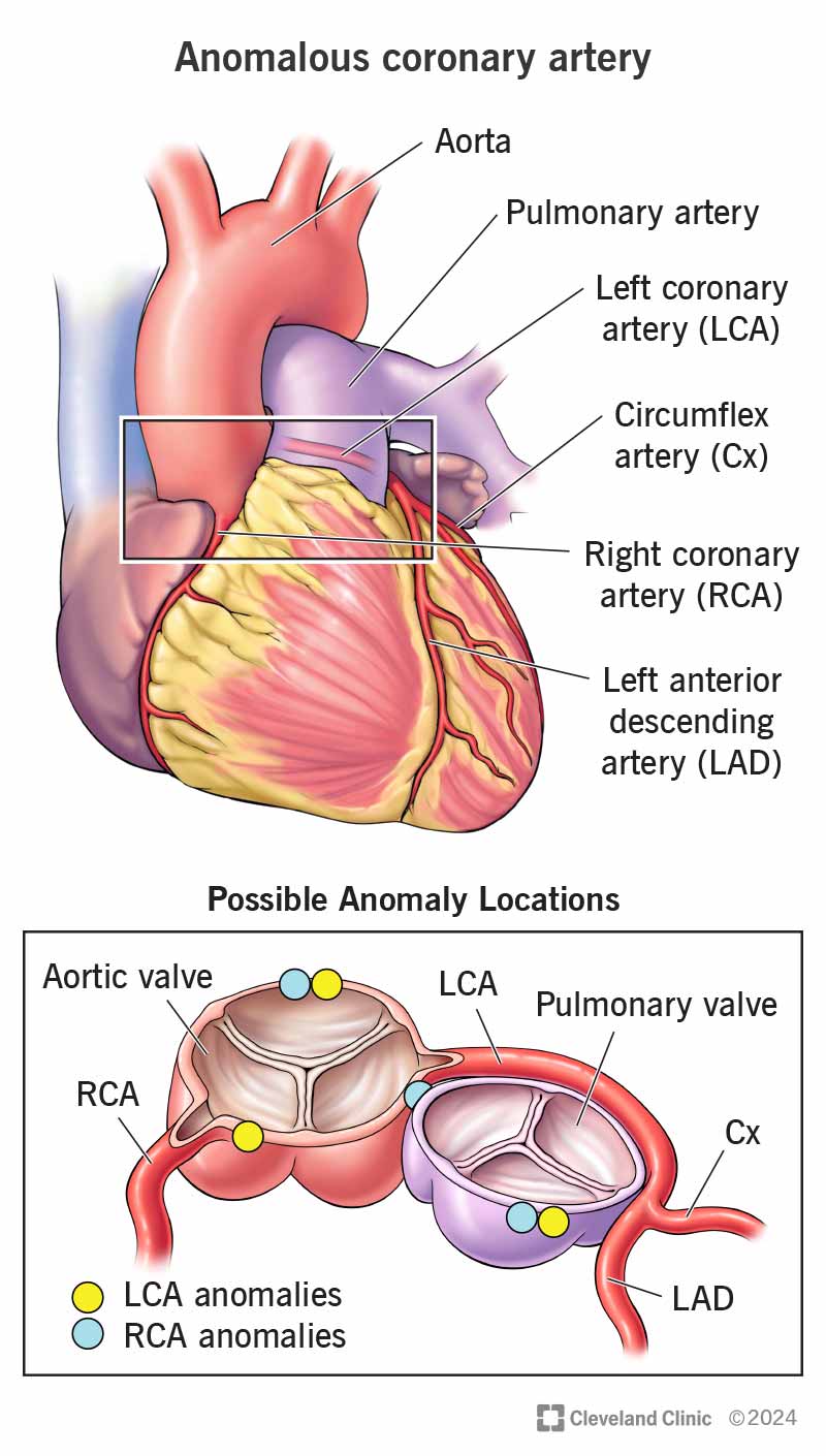 An anomalous coronary artery can be in several unusual locations, which can change how blood flows through your heart