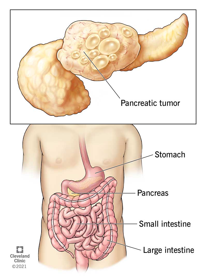 The pancreas in the abdomen, along with a tumor on the pancreas.