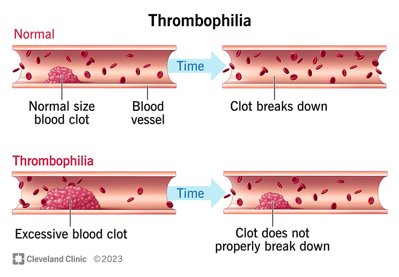 Comparing blood clots in a blood vessel with and without thrombophilia