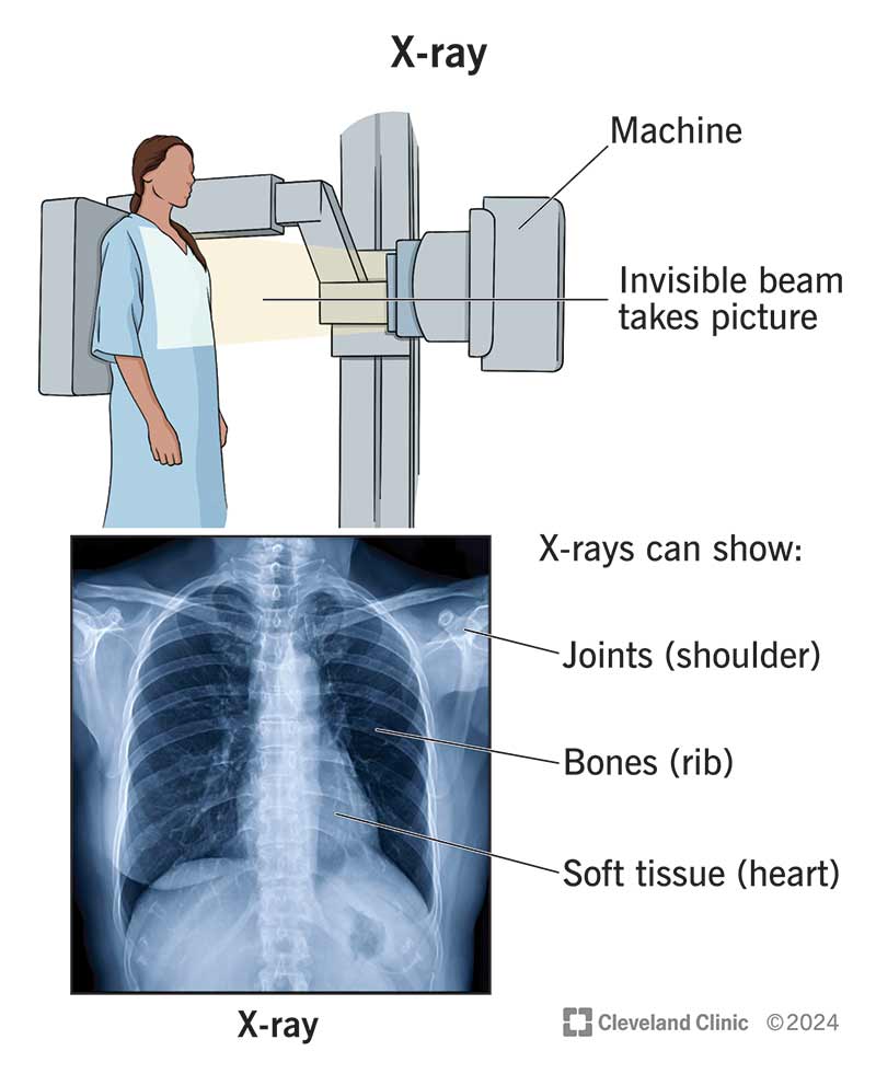 Illustration of machine taking chest X-ray. Additionally, a chest X-ray is labeled to show should joint, bones and heart.