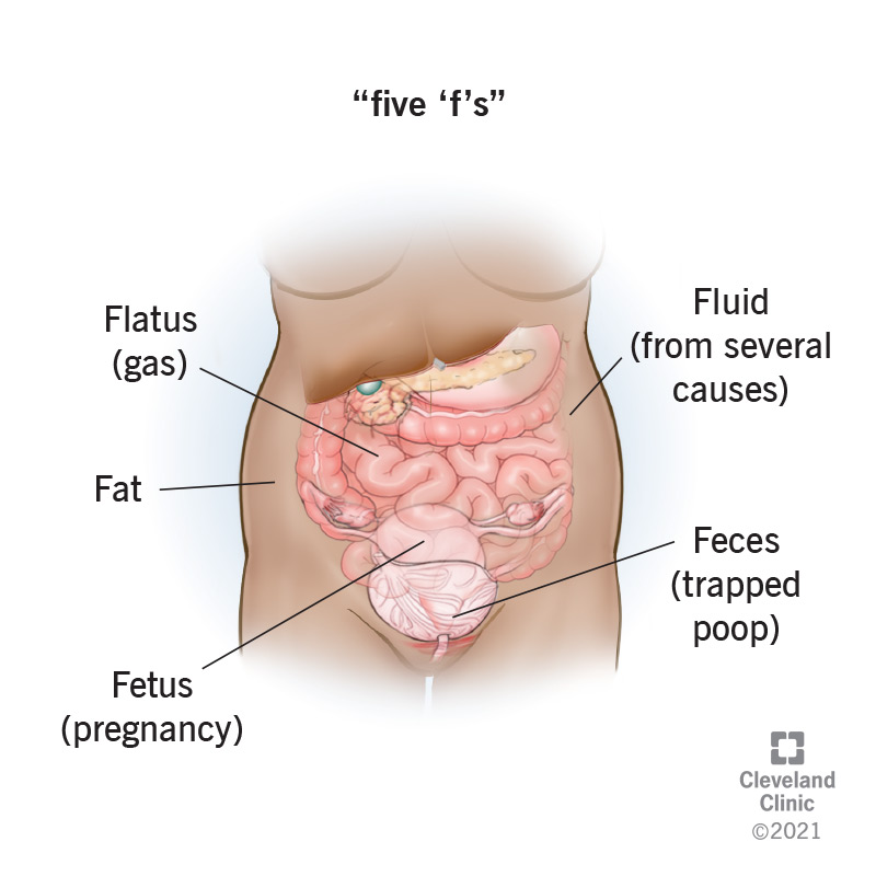The main causes of generalised abdominal distension are Fat, Faeces, Fetus, Flatus, and Fluid.
