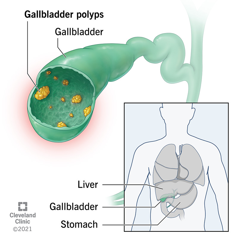 Gallbladder polyps are growths on the inside lining of your gallbladder. The gallbladder is an organ in the digestive system.