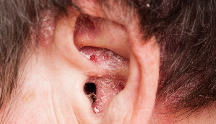 Eczema in the inner ear and outside of the ear.