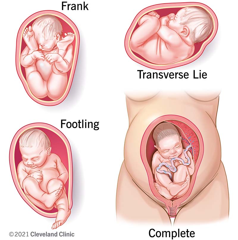Types of breech positions during pregnancy.