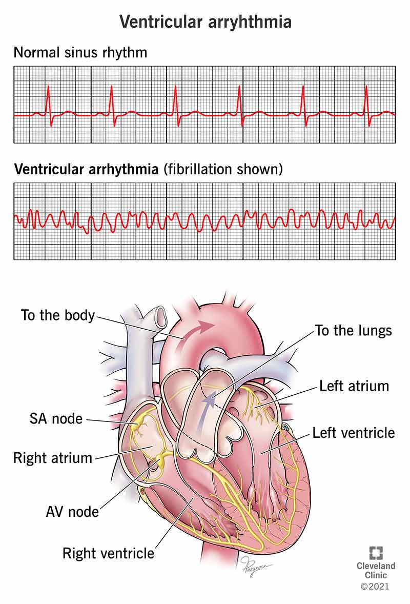 EKG showing ventricular arrhythmia.