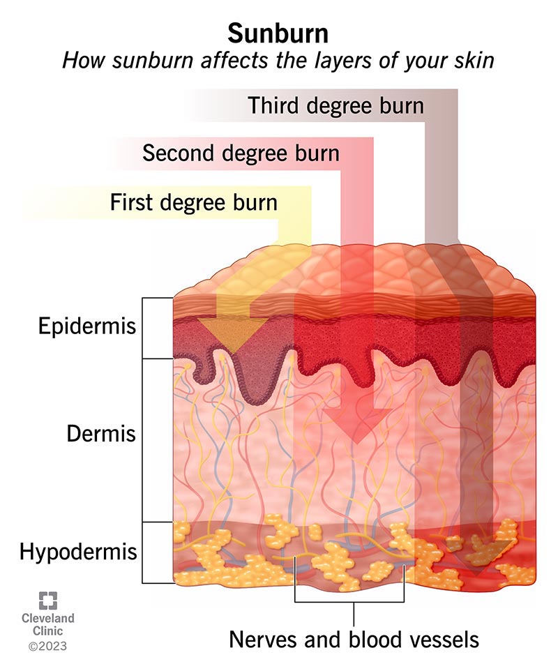 Sunburn: Symptoms & Treatment