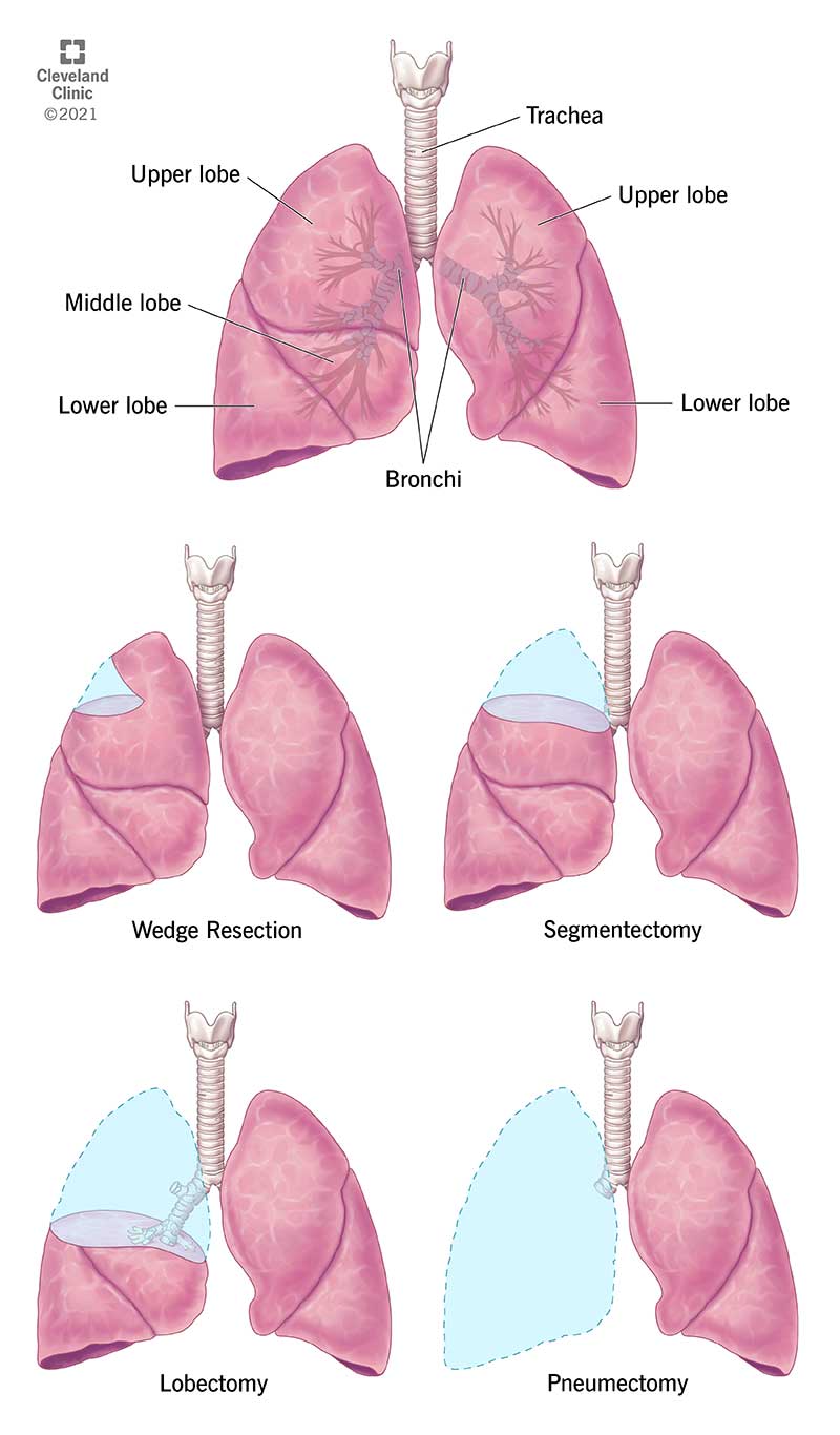 Diagram of lungs, and illustrative examples of different types of lung resection.