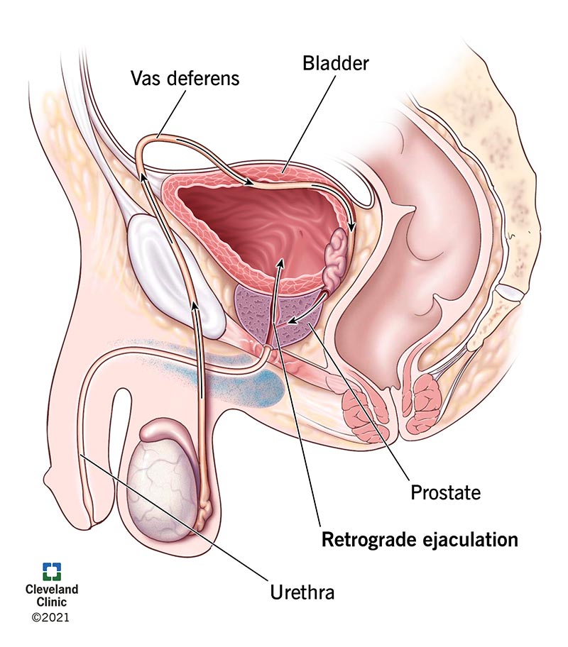 Medical illustration of the male reproductive system showing the path of semen into the bladder due to retrograde ejaculation.