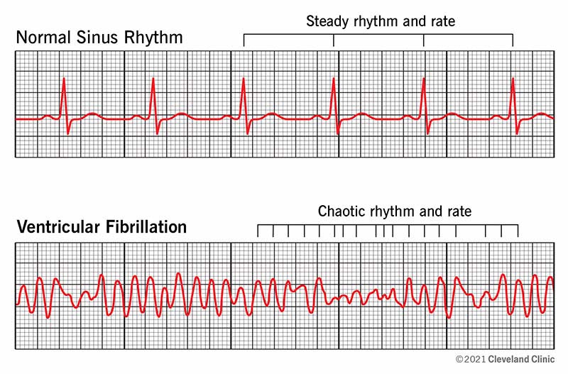 Ventricular fibrillation electrocardiogram