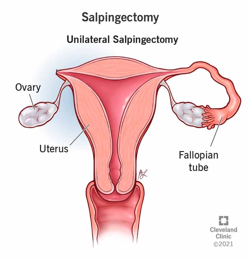 Removal of the fallopian tube