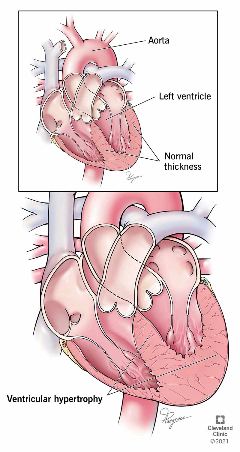 diagram of left ventricular hypertrophy