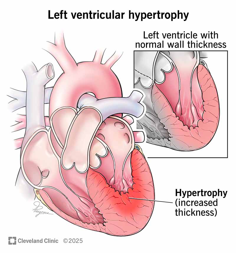 diagram of left ventricular hypertrophy