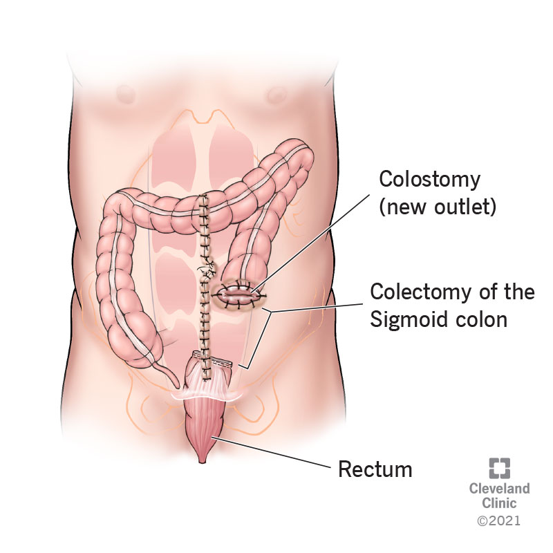 Hartmann’s procedure with colostomy and colectomy of the sigmoid colon