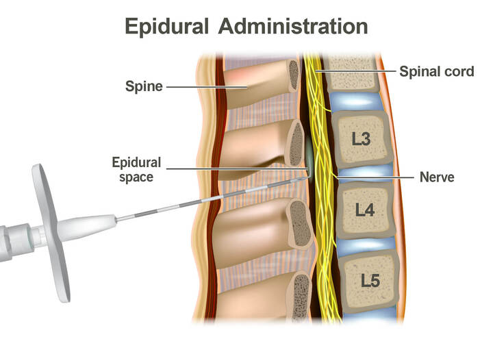 Think about taking an epidural during work