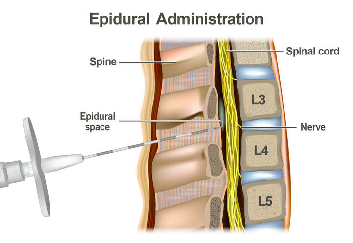 Epidural Steroid Injection for Back Pain: How Long Does It Last