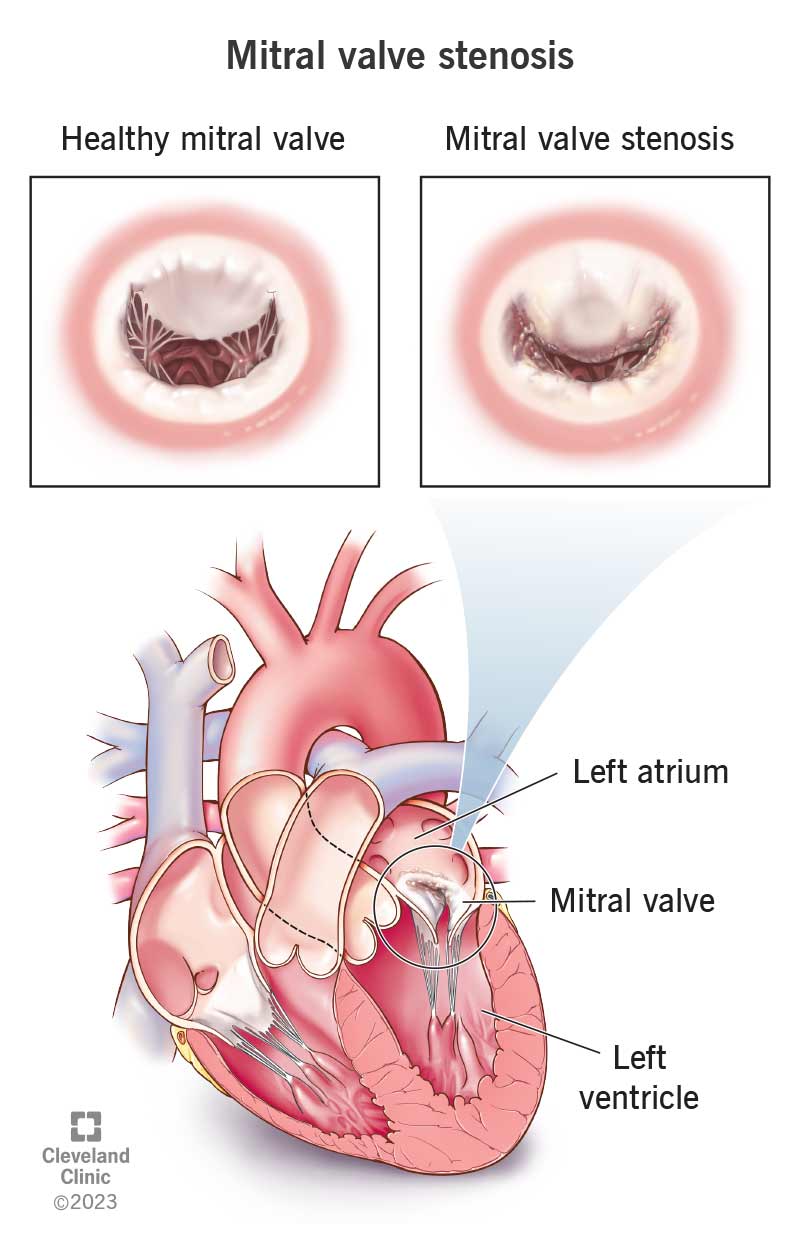 Mitral valve stenosis is a narrow opening for blood to flow between your heart’s left chambers.