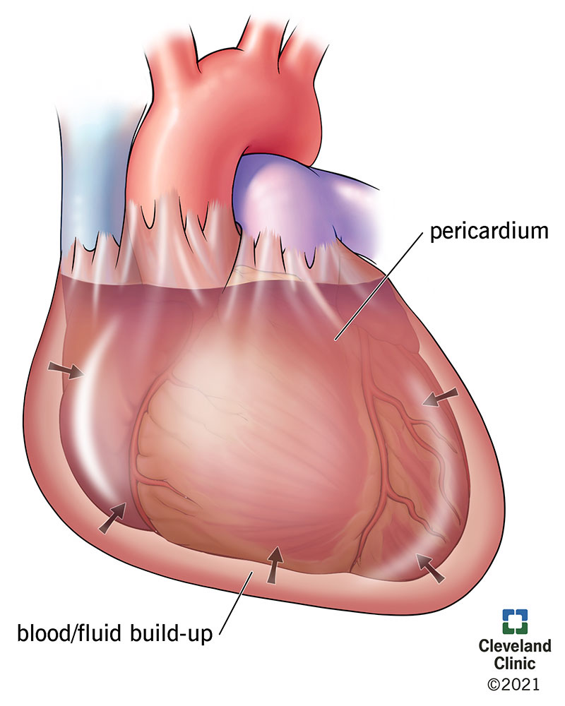 The heart and surrounding pericardial sac, with fluid inside the sac pressing inward on the heart.