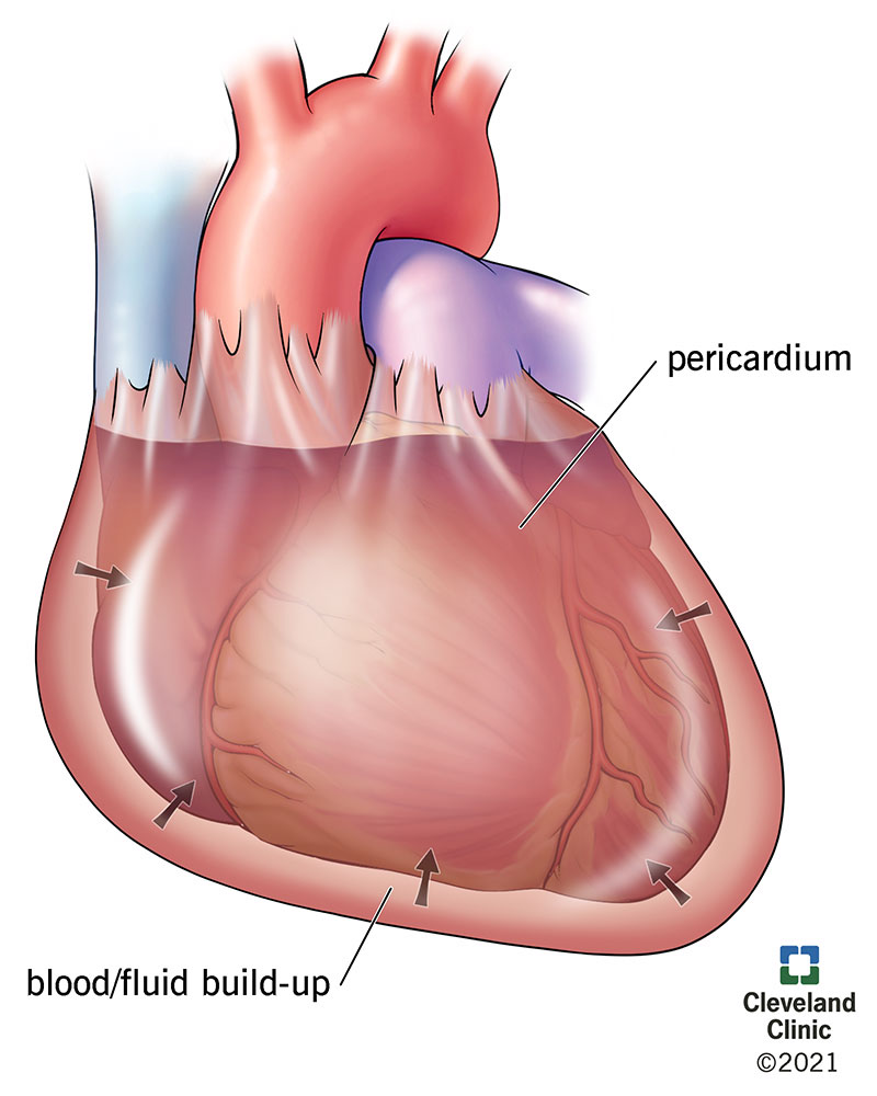 fluid in the pericardial sac