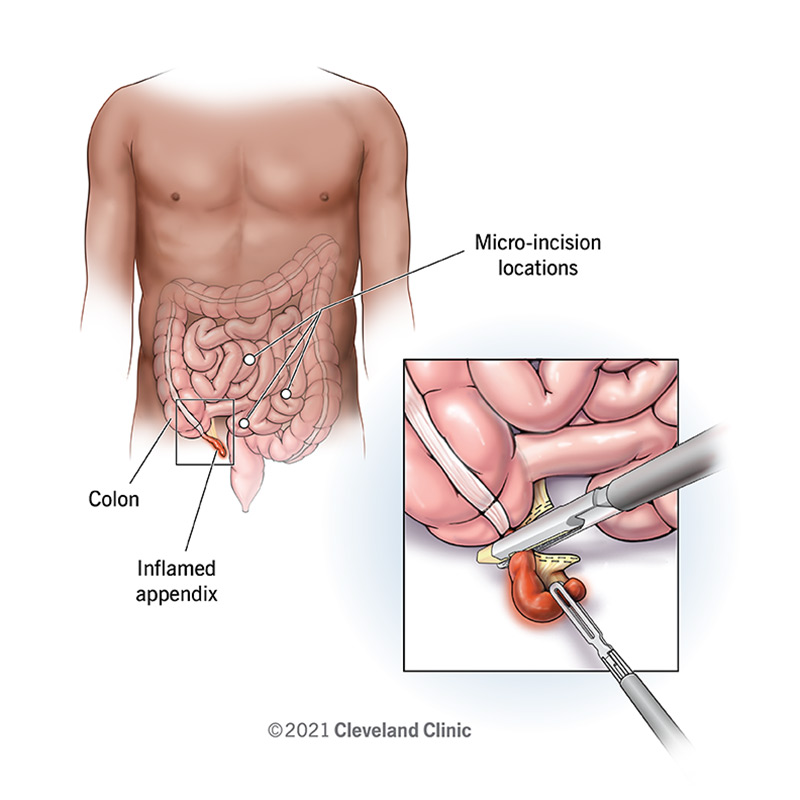 Laparoscopic appendectomy removes inflamed appendix using micro-incisions and small surgical instruments