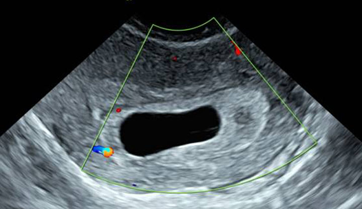 Ultrasound of an empty gestational sac or blighted ovum.