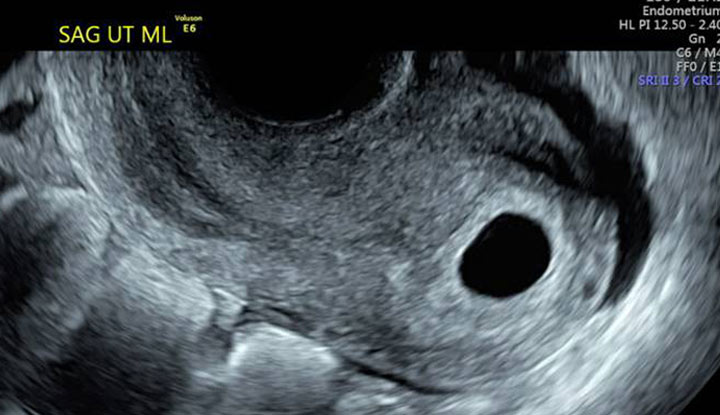 Normal early pregnancy imaging