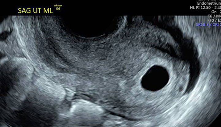 Ultrasound of an empty gestational sac or blighted ovum.