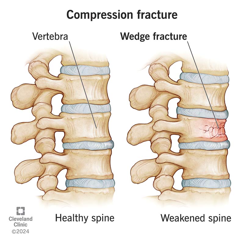 Comparison of healthy spine and weakened spine with a compression fracture